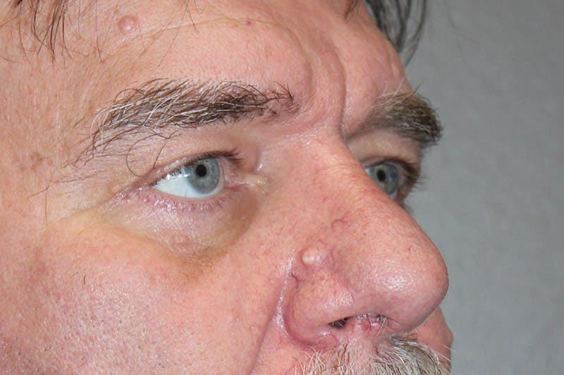 Eyelid surgery Before & After Gallery - Patient 174901504 - Image 4