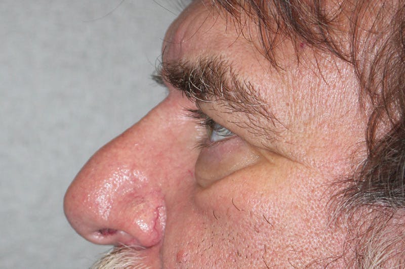 Eyelid surgery Before & After Gallery - Patient 174901504 - Image 9