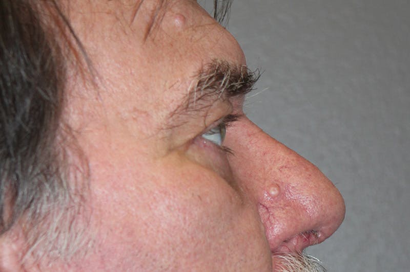 Eyelid surgery Before & After Gallery - Patient 174901504 - Image 8