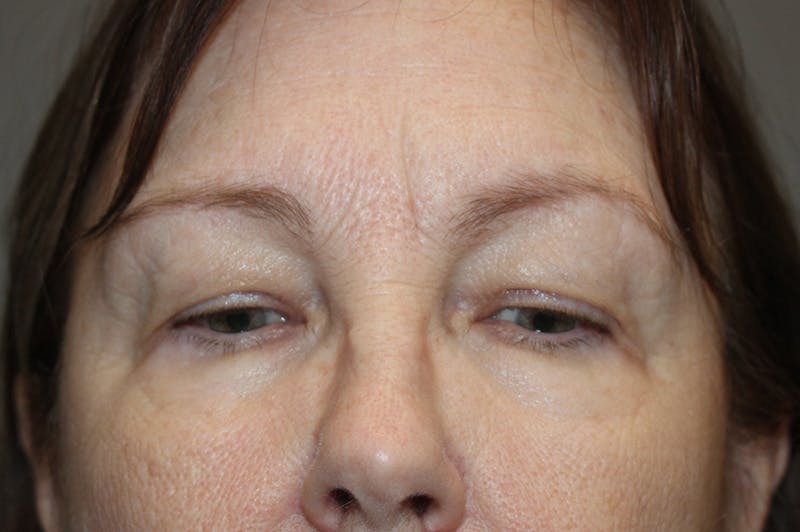 Eyelid surgery Before & After Gallery - Patient 174973058 - Image 1