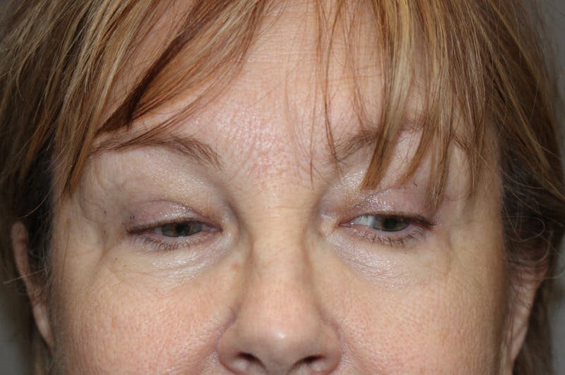 Eyelid surgery Before & After Gallery - Patient 174973058 - Image 2