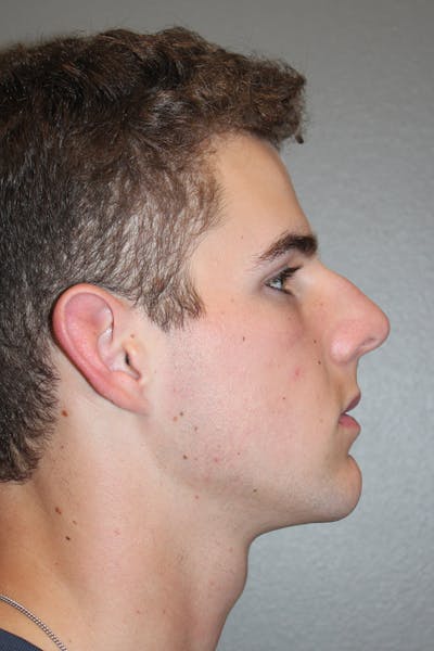 Rhinoplasty Before & After Gallery - Patient 174971770 - Image 1
