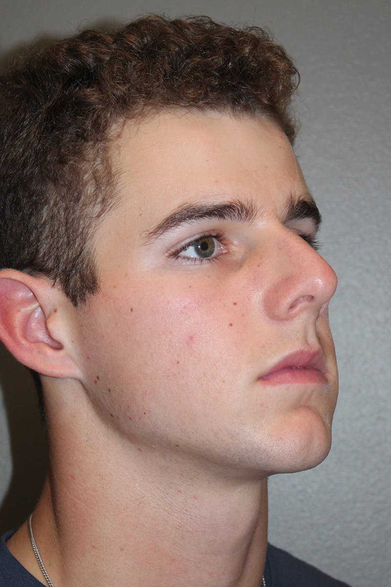 Rhinoplasty Before & After Gallery - Patient 174971770 - Image 3
