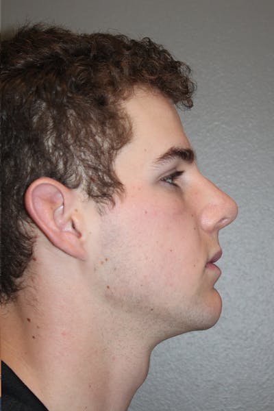 Rhinoplasty Before & After Gallery - Patient 174971770 - Image 2