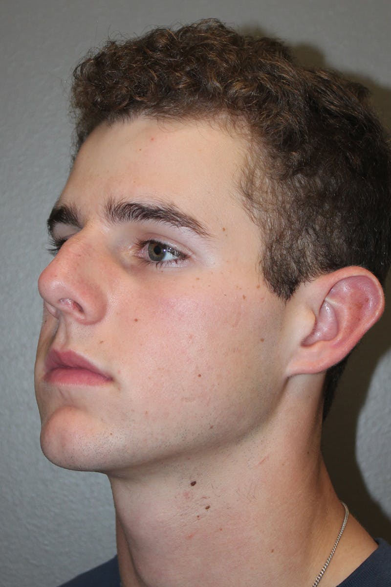 Rhinoplasty Before & After Gallery - Patient 174971770 - Image 7