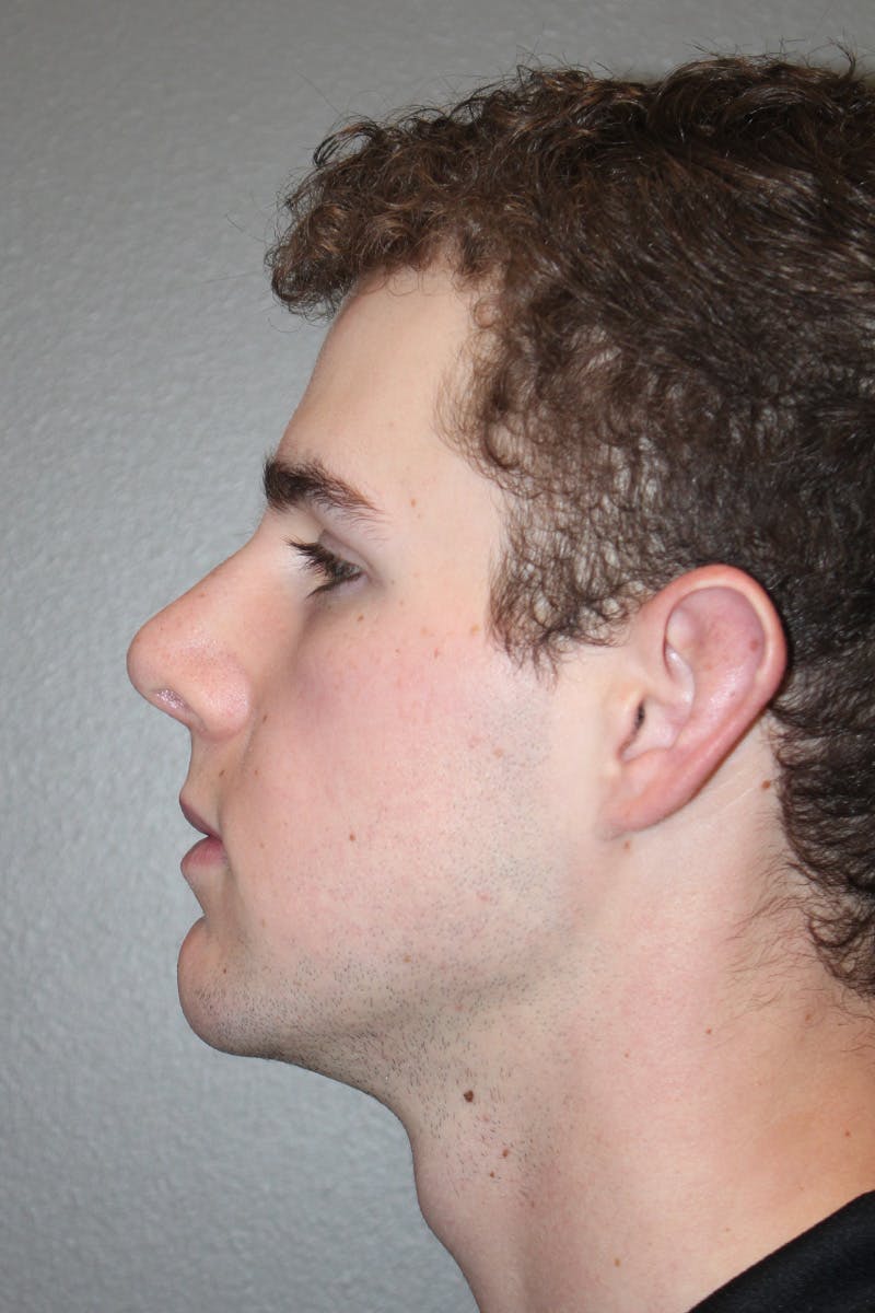 Rhinoplasty Before & After Gallery - Patient 174971770 - Image 10