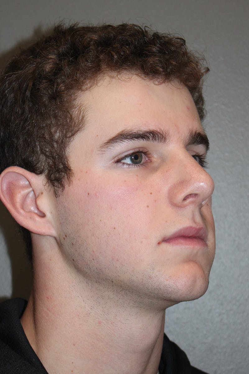Rhinoplasty Before & After Gallery - Patient 174971770 - Image 4