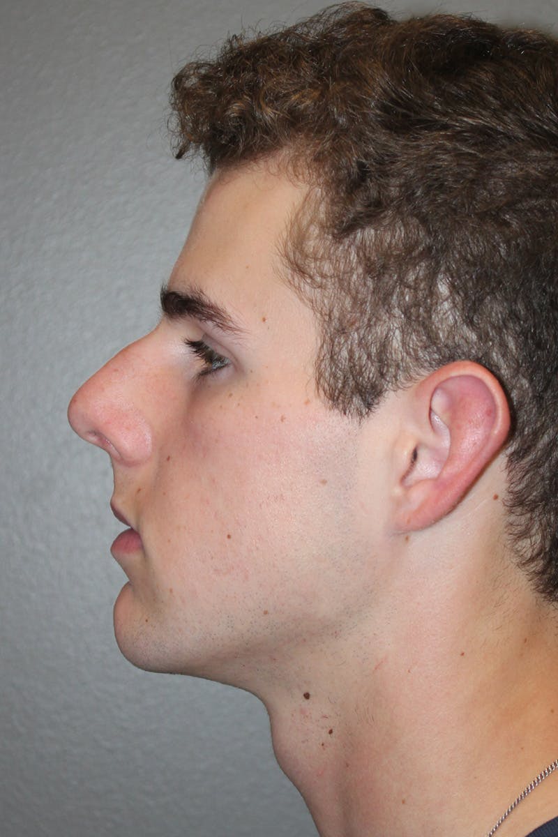Rhinoplasty Before & After Gallery - Patient 174971770 - Image 9