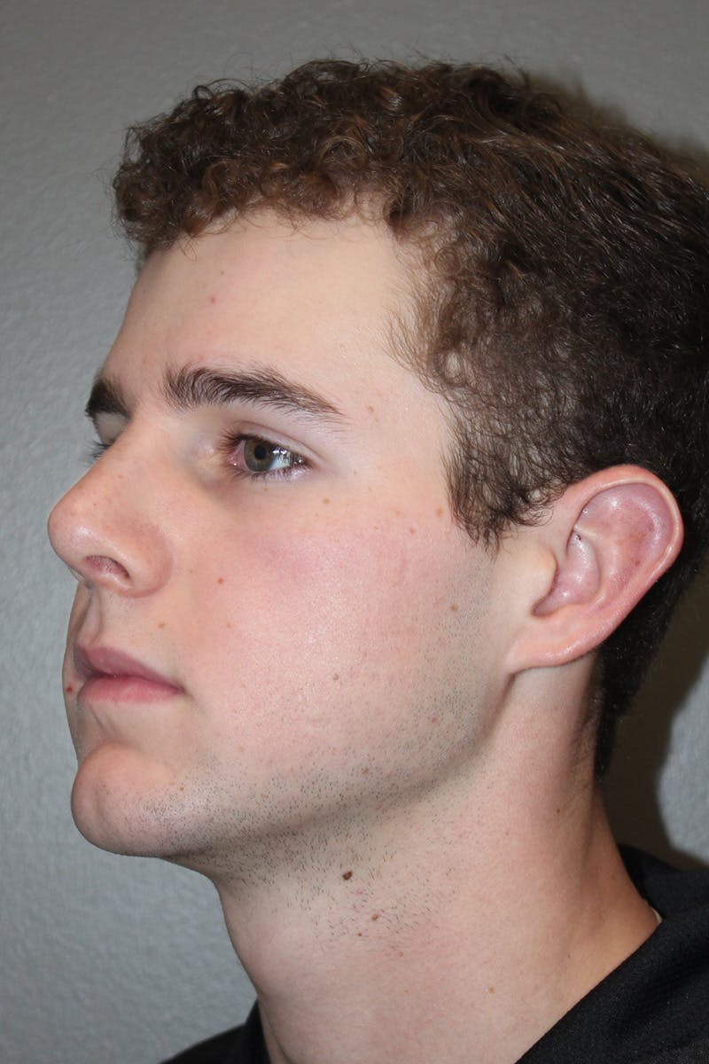 Rhinoplasty Before & After Gallery - Patient 174971770 - Image 8