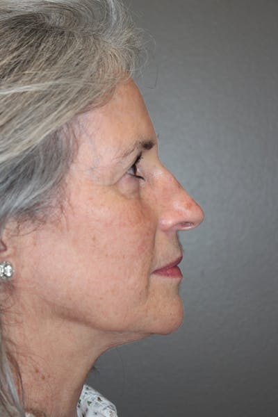 Rhinoplasty Before & After Gallery - Patient 174971771 - Image 1