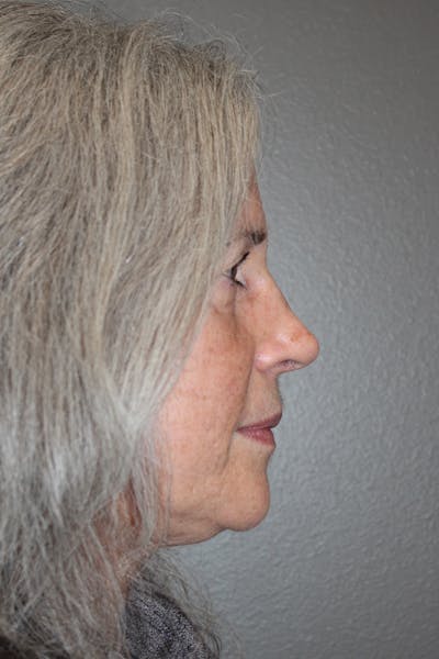 Rhinoplasty Before & After Gallery - Patient 174971771 - Image 2