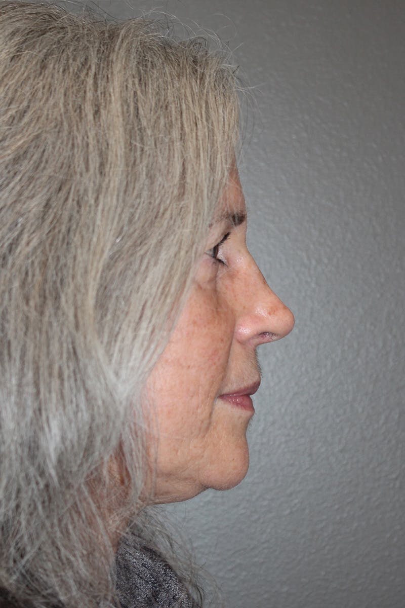 Rhinoplasty Before & After Gallery - Patient 174971771 - Image 2
