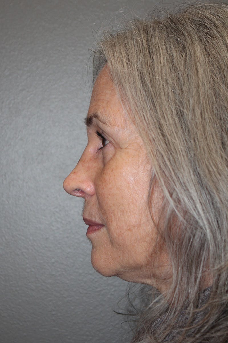 Rhinoplasty Before & After Gallery - Patient 174971771 - Image 10