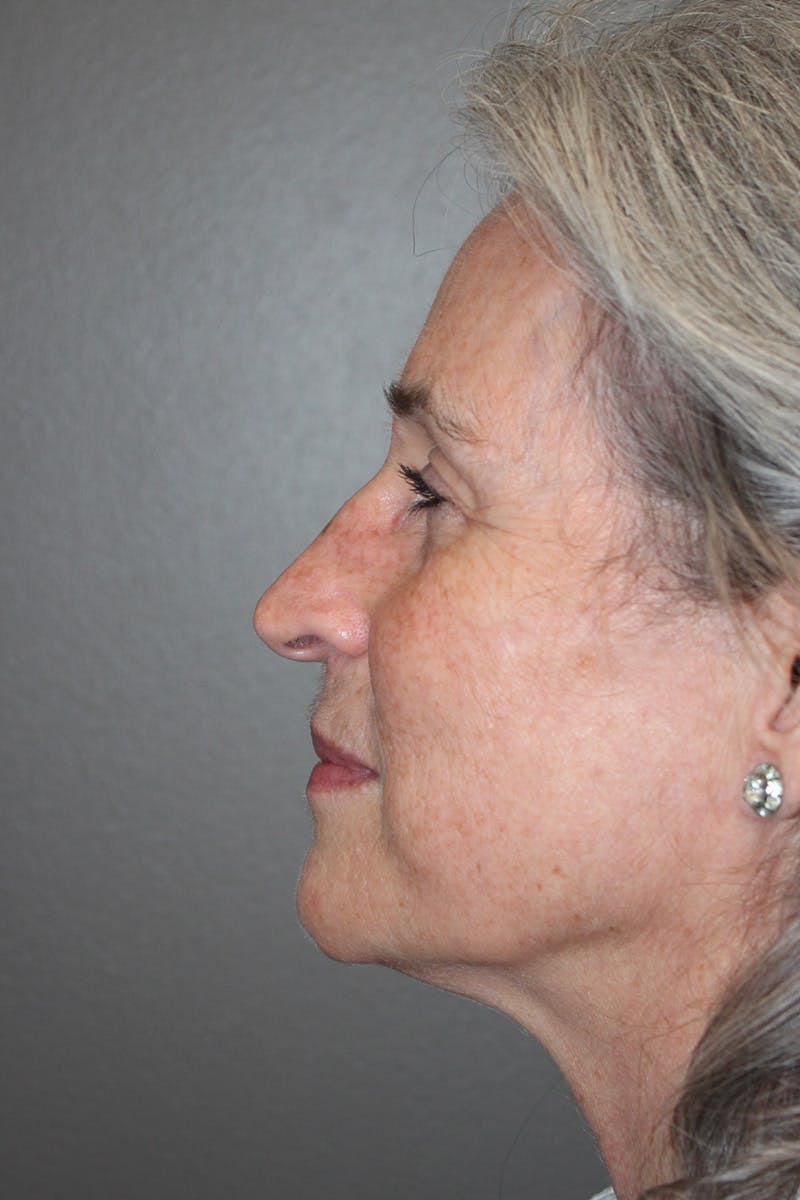 Rhinoplasty Before & After Gallery - Patient 174971771 - Image 9