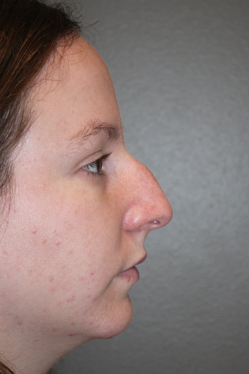 Rhinoplasty Before & After Gallery - Patient 174971772 - Image 1