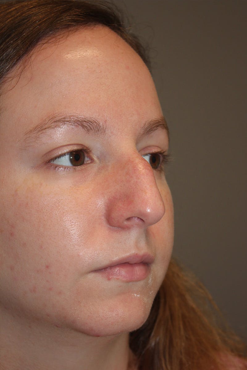 Rhinoplasty Before & After Gallery - Patient 174971772 - Image 3
