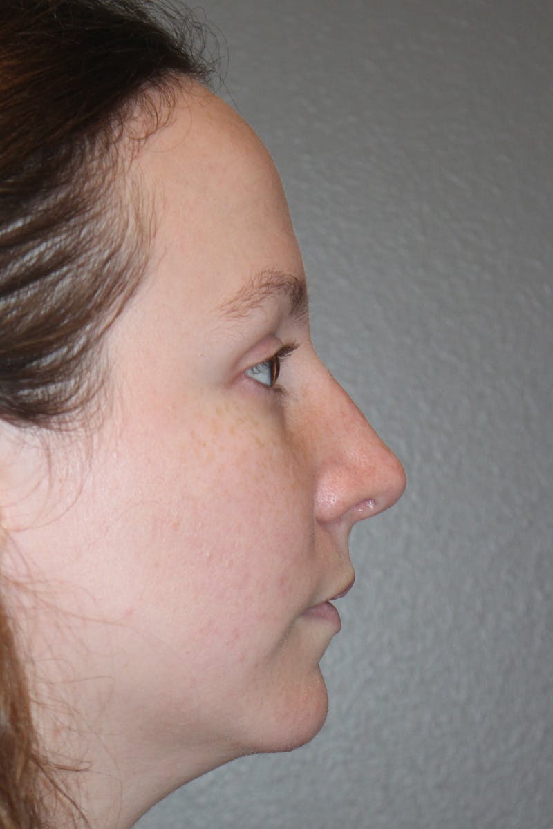 Rhinoplasty Before & After Gallery - Patient 174971772 - Image 2