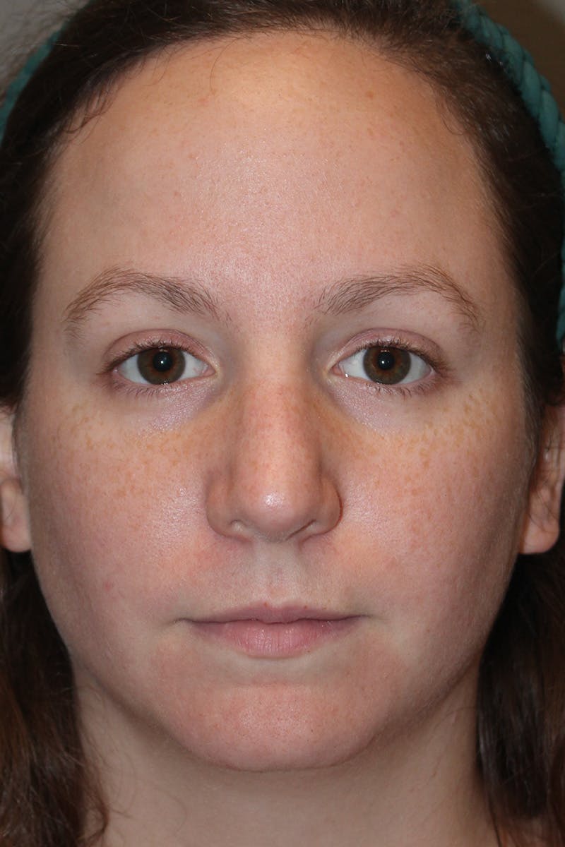 Rhinoplasty Before & After Gallery - Patient 174971772 - Image 6