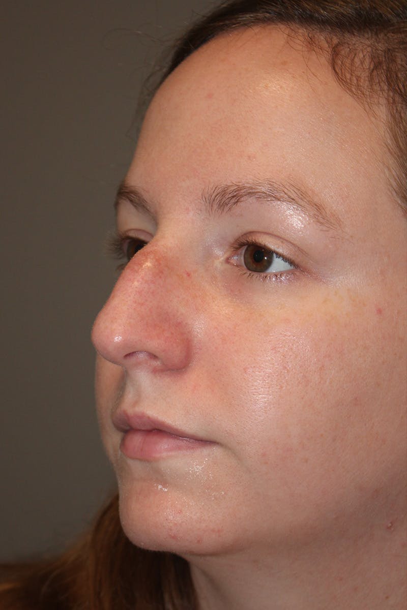 Rhinoplasty Before & After Gallery - Patient 174971772 - Image 7