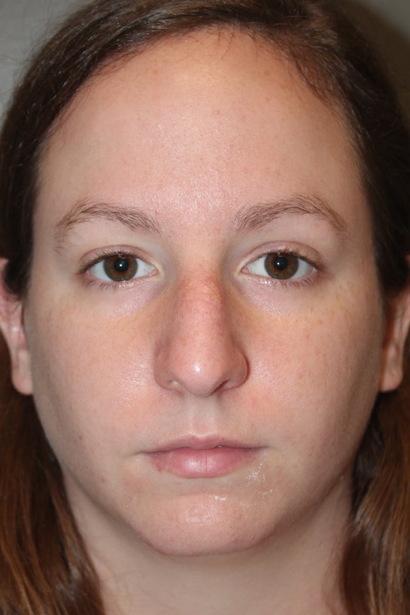 Rhinoplasty Before & After Gallery - Patient 174971772 - Image 5