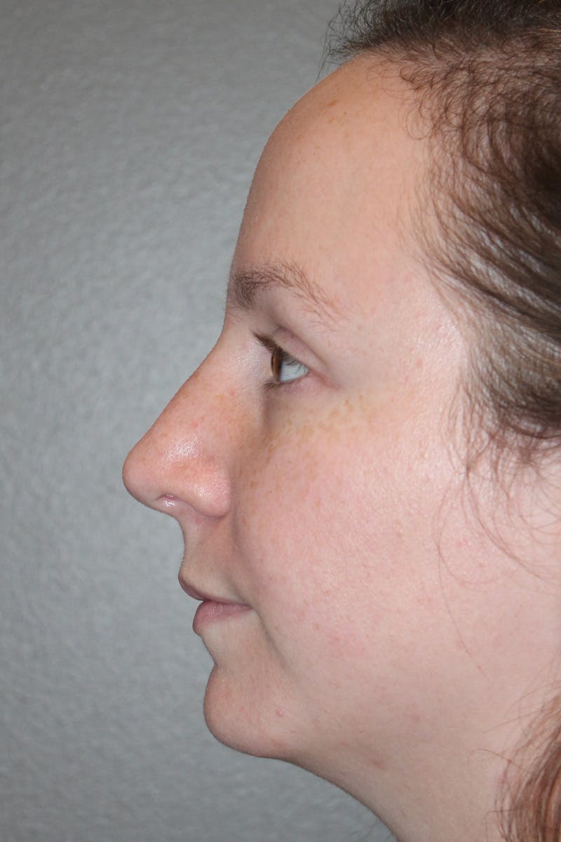 Rhinoplasty Before & After Gallery - Patient 174971772 - Image 10