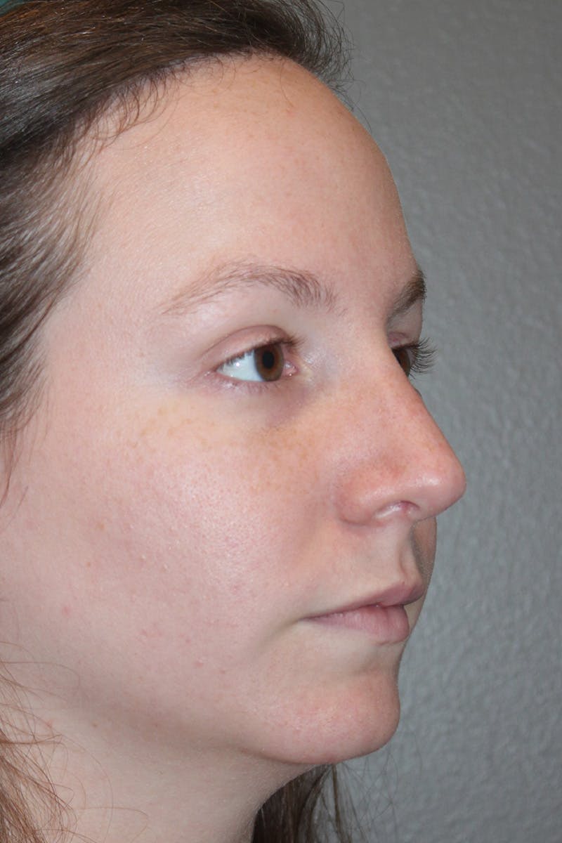 Rhinoplasty Before & After Gallery - Patient 174971772 - Image 4