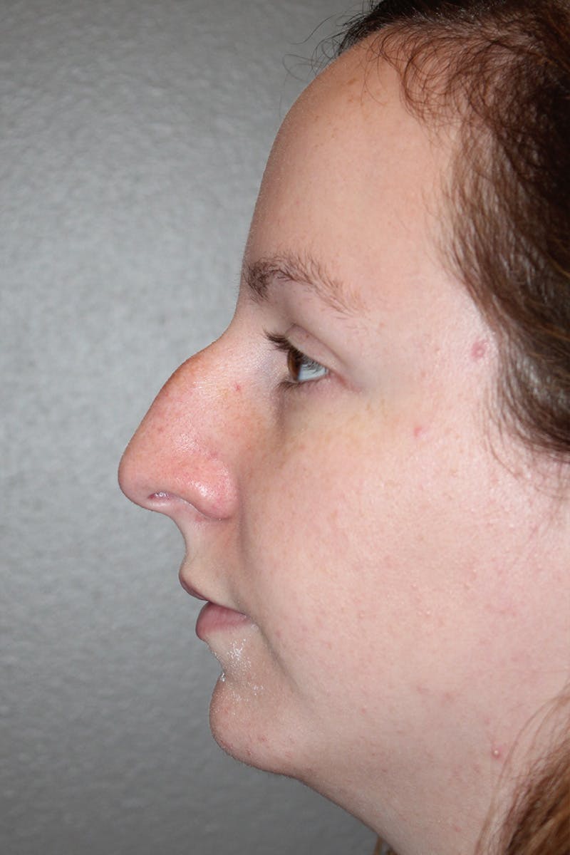 Rhinoplasty Before & After Gallery - Patient 174971772 - Image 9