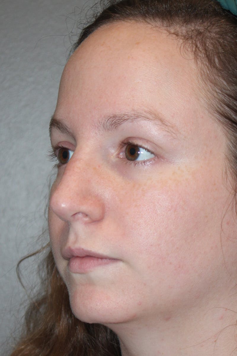 Rhinoplasty Before & After Gallery - Patient 174971772 - Image 8