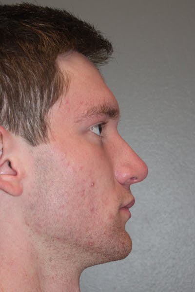 Rhinoplasty Before & After Gallery - Patient 174972016 - Image 2