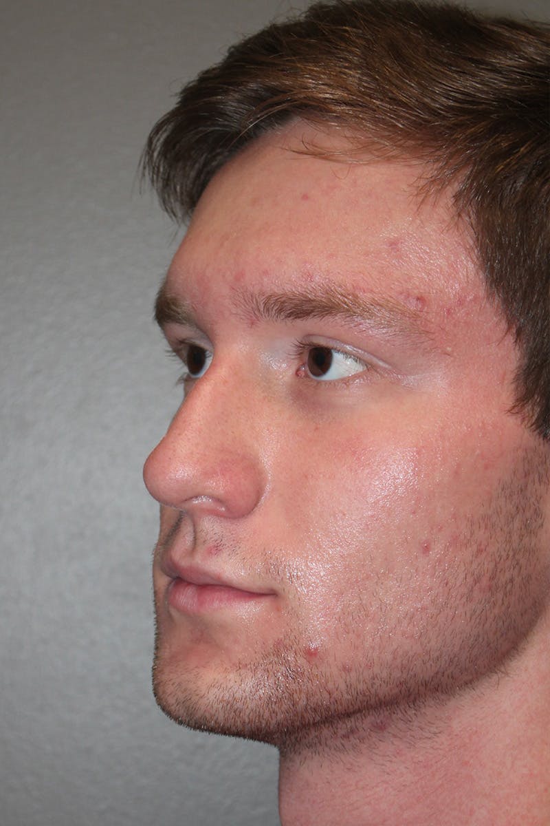 Rhinoplasty Before & After Gallery - Patient 174972016 - Image 7
