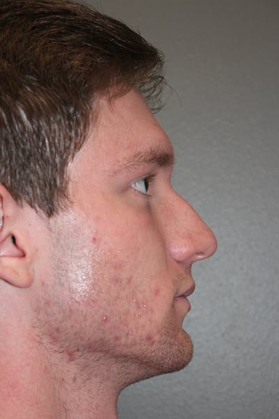 Rhinoplasty Before & After Gallery - Patient 174972016 - Image 1