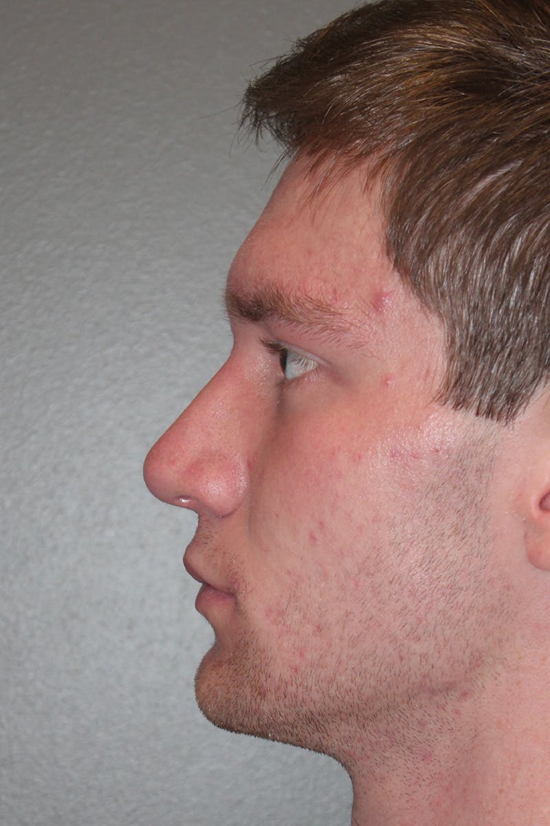 Rhinoplasty Before & After Gallery - Patient 174972016 - Image 10