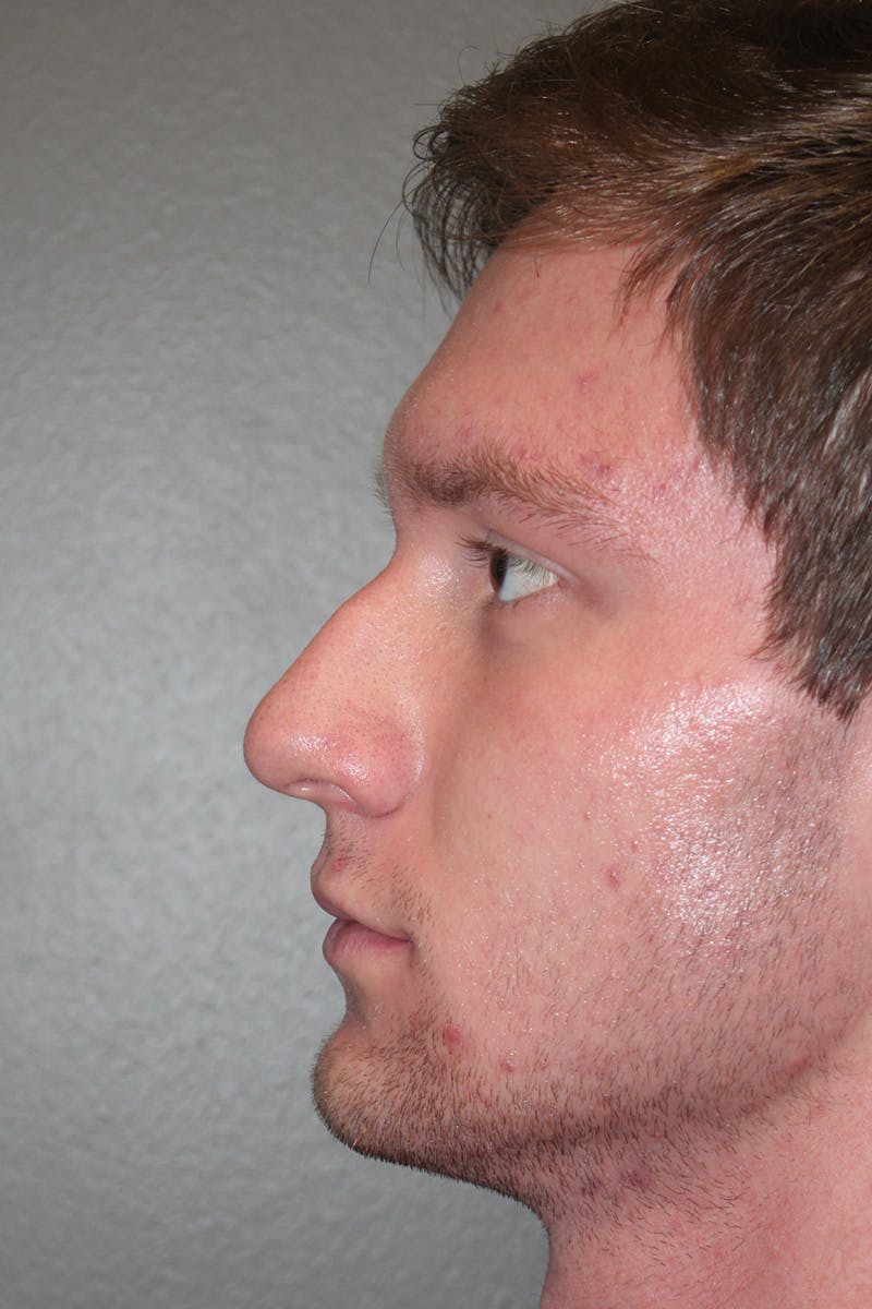 Rhinoplasty Before & After Gallery - Patient 174972016 - Image 9
