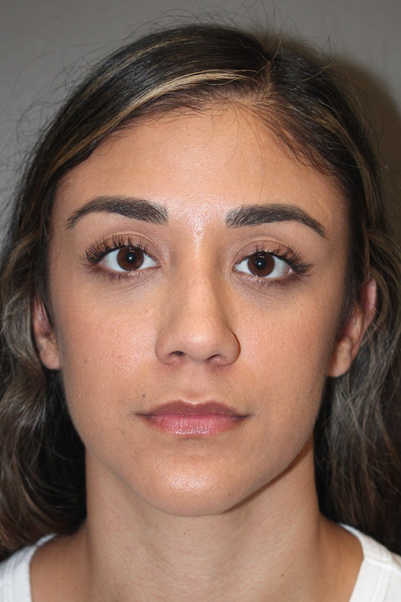 Rhinoplasty Before & After Gallery - Patient 174972177 - Image 5