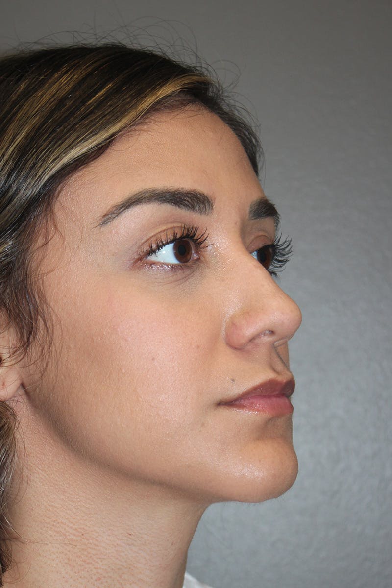 Rhinoplasty Before & After Gallery - Patient 174972177 - Image 3