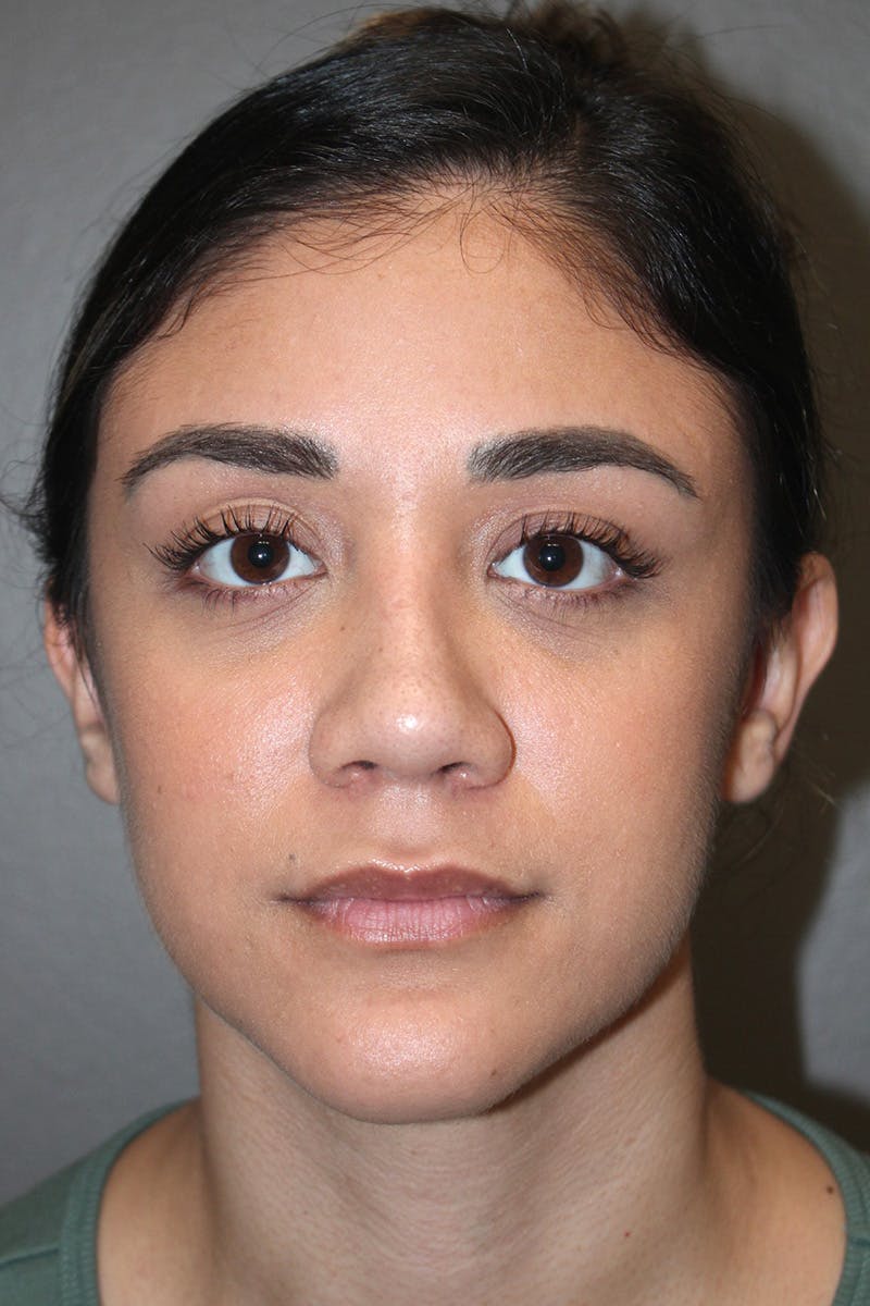 Rhinoplasty Before & After Gallery - Patient 174972177 - Image 6