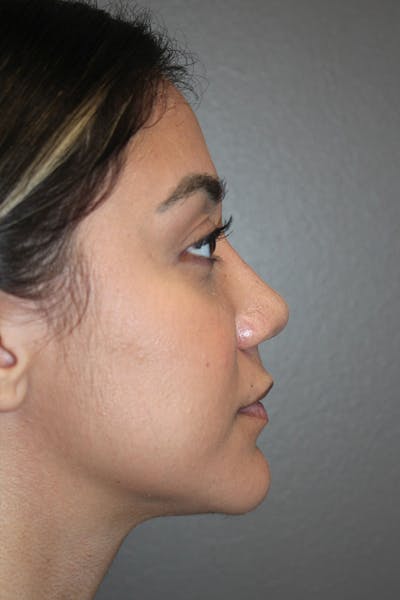 Rhinoplasty Before & After Gallery - Patient 174972177 - Image 2