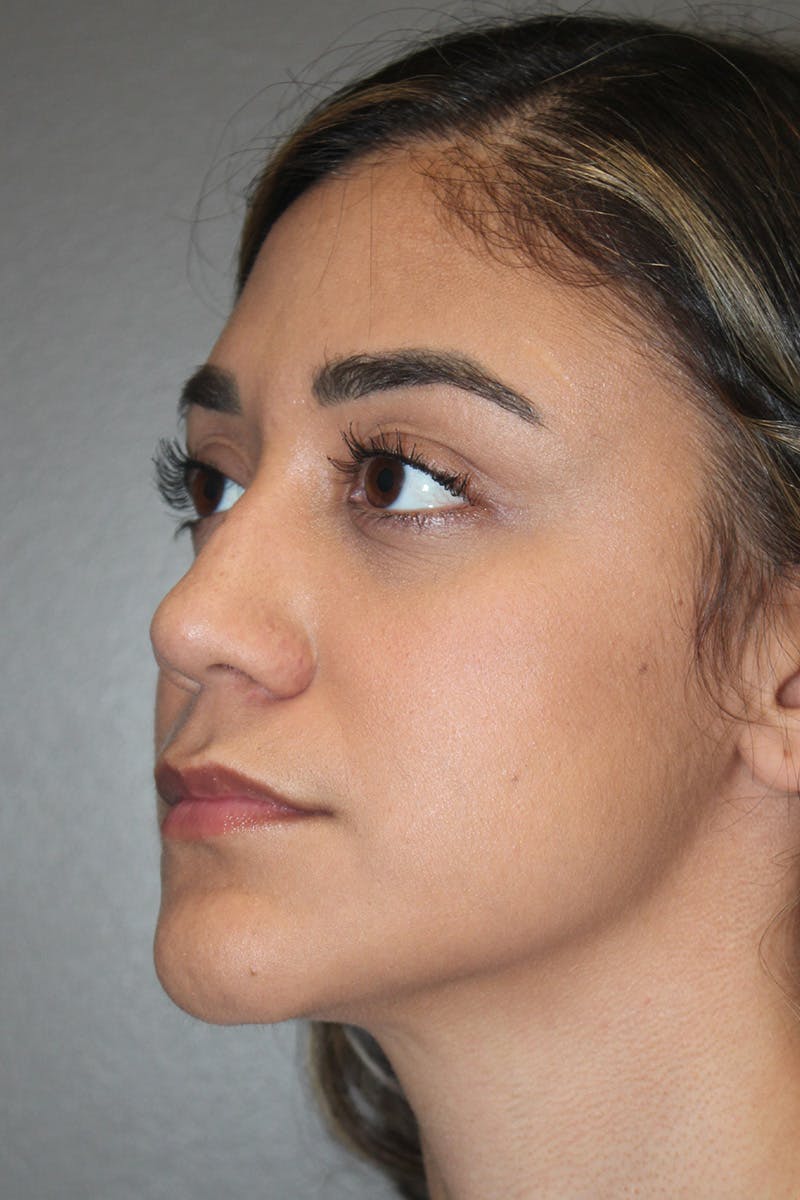Rhinoplasty Before & After Gallery - Patient 174972177 - Image 7