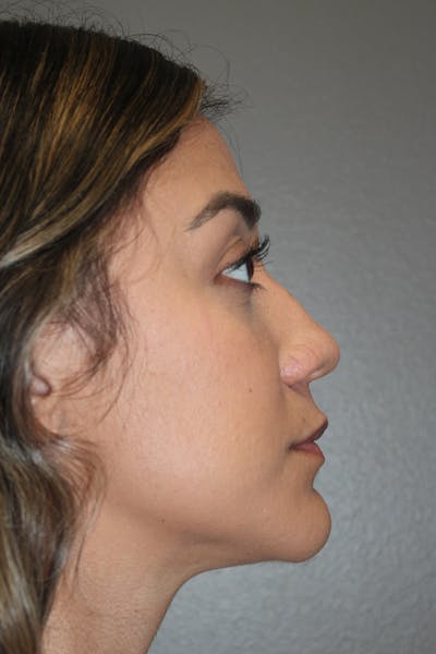 Rhinoplasty Before & After Gallery - Patient 174972177 - Image 1