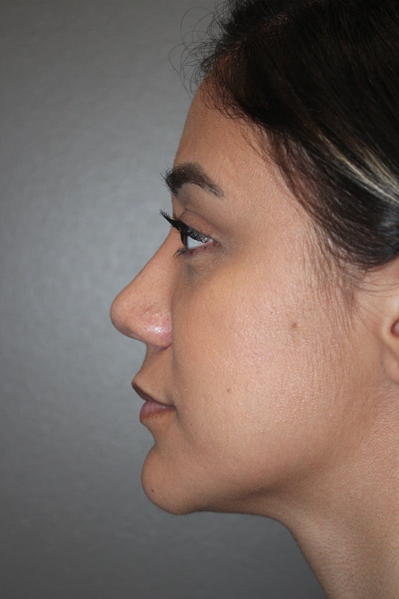 Rhinoplasty Before & After Gallery - Patient 174972177 - Image 10