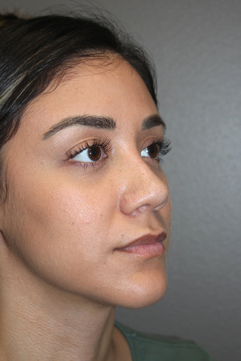 Rhinoplasty Before & After Gallery - Patient 174972177 - Image 4