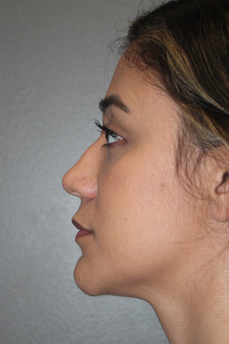 Rhinoplasty Before & After Gallery - Patient 174972177 - Image 9