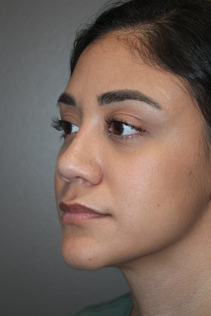 Rhinoplasty Before & After Gallery - Patient 174972177 - Image 8