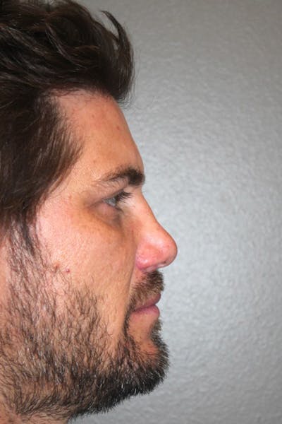 Rhinoplasty Before & After Gallery - Patient 174972180 - Image 1