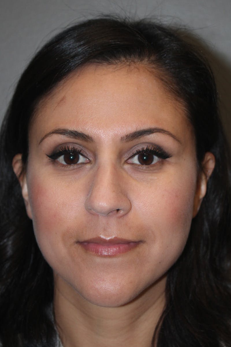 Rhinoplasty Before & After Gallery - Patient 174972181 - Image 5