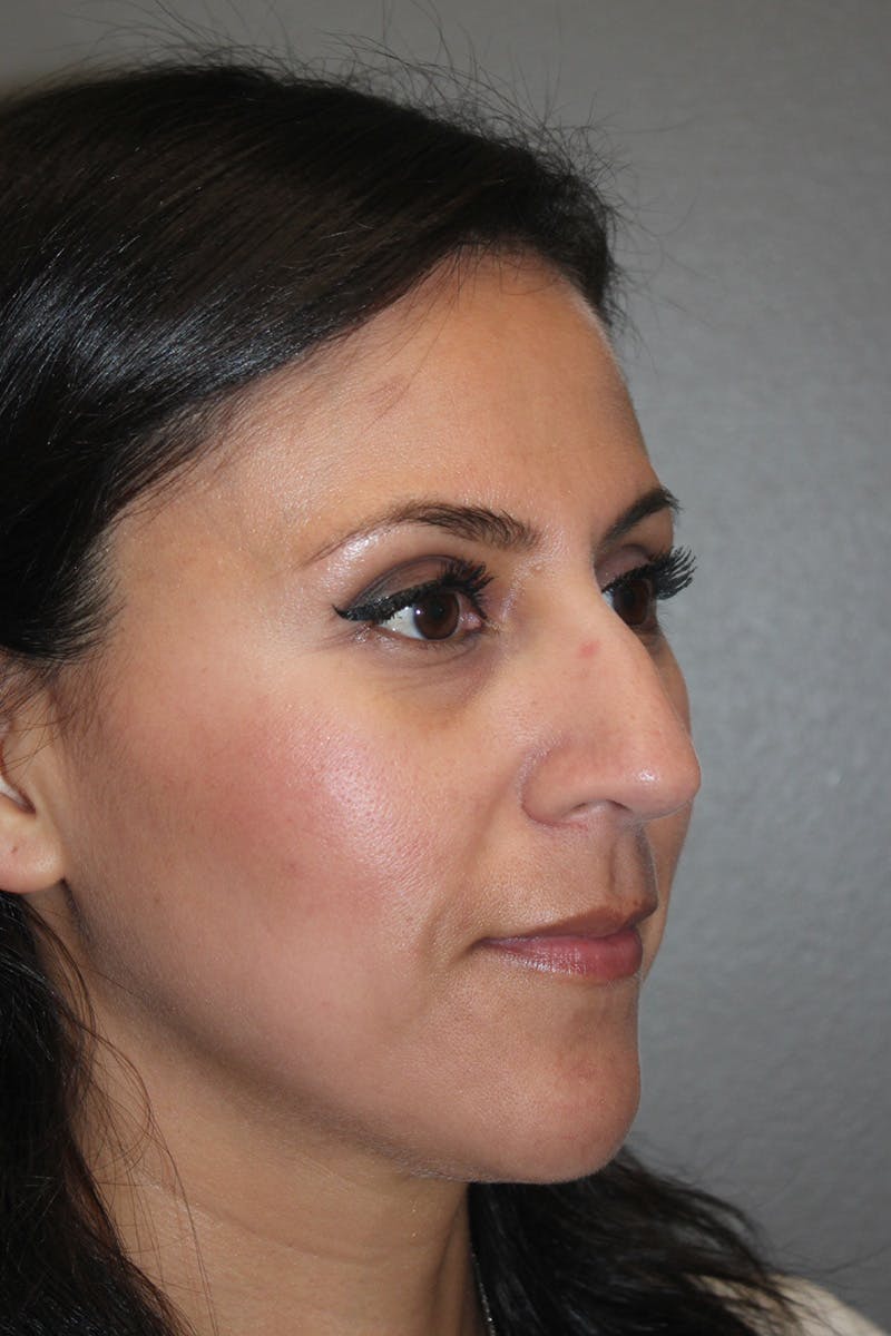 Rhinoplasty Before & After Gallery - Patient 174972181 - Image 3