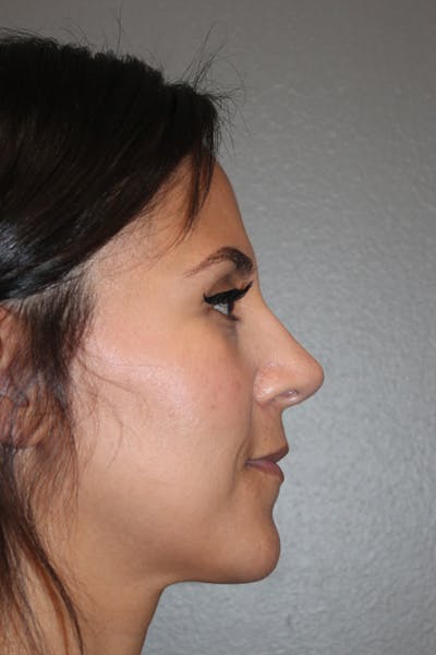 Rhinoplasty Before & After Gallery - Patient 174972181 - Image 2