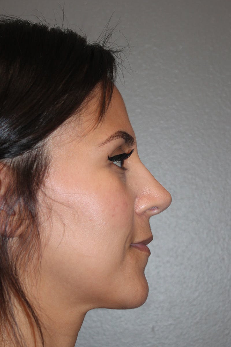 Rhinoplasty Before & After Gallery - Patient 174972181 - Image 2
