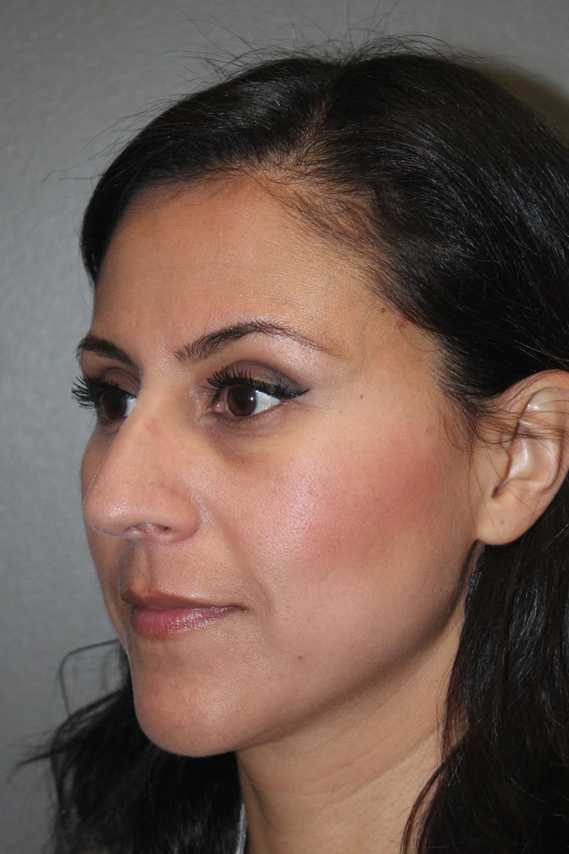 Rhinoplasty Before & After Gallery - Patient 174972181 - Image 7