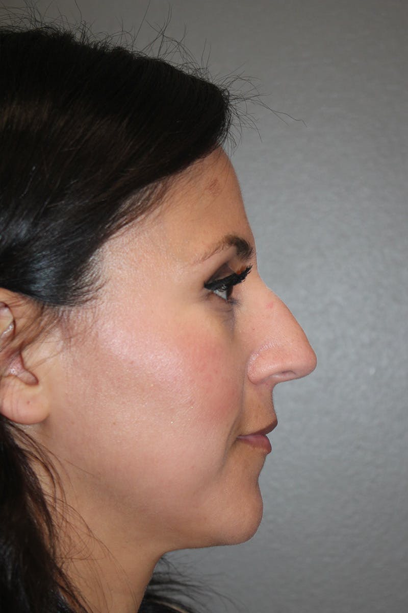 Rhinoplasty Before & After Gallery - Patient 174972181 - Image 1